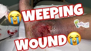 Weeping Wound [upl. by Plafker]