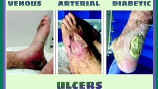 ARTERIAL VENOUS amp DIABETIC ULCERS  Chronic WoundsPart II [upl. by Jervis774]